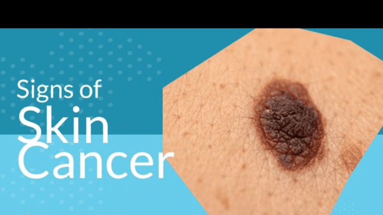 What type of cancer does Ninja have?And Early skin cancer symptoms-